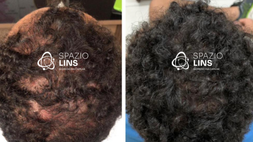 Meu cabelo está caindo muito. O que fazer? - Spazio Lins