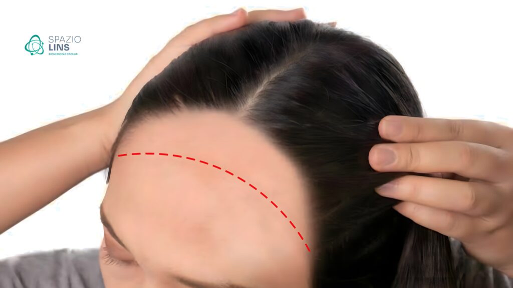Alopecia Cicatricial tem tratamento?