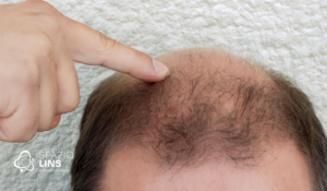 Formigamento no couro cabeludo: o que pode ser?
