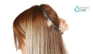 O que é Alopecia Entenda as Causas Tipos e Tratamentos 2