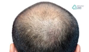 O que é Alopecia Entenda as Causas Tipos e Tratamentos