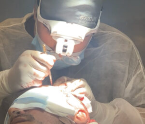 Antes e depois do transplante capilar: o que esperar do procedimento?