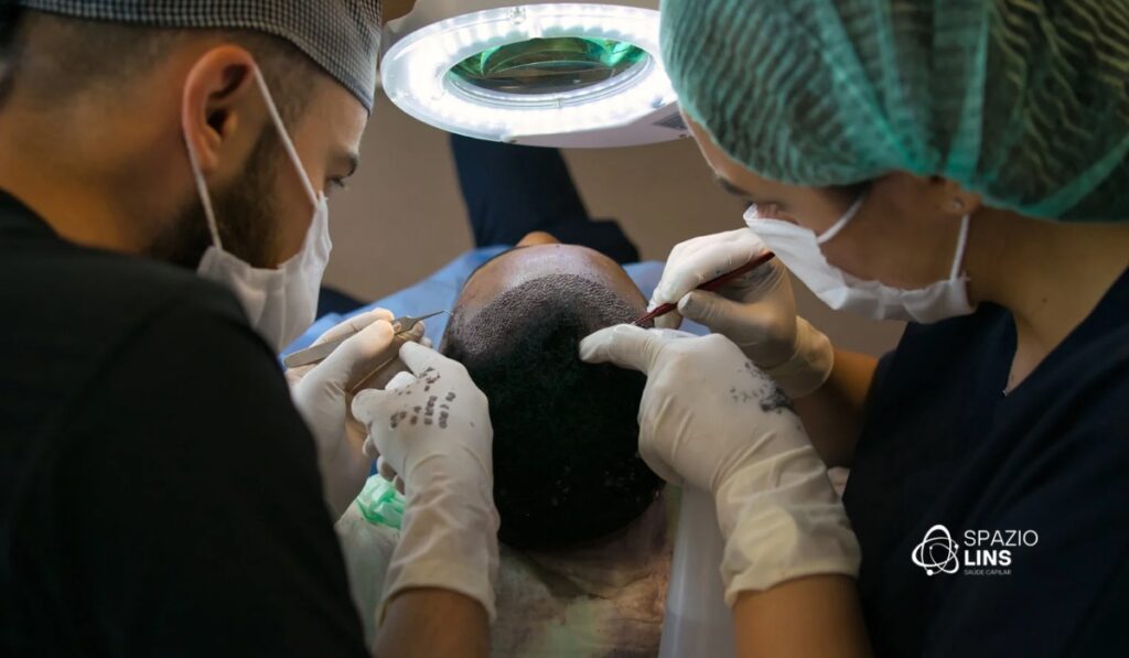 Qual termo é correto: Transplante Capilar ou Implante Capilar?