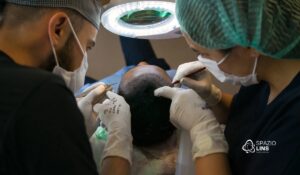 Qual termo é correto: Transplante Capilar ou Implante Capilar?