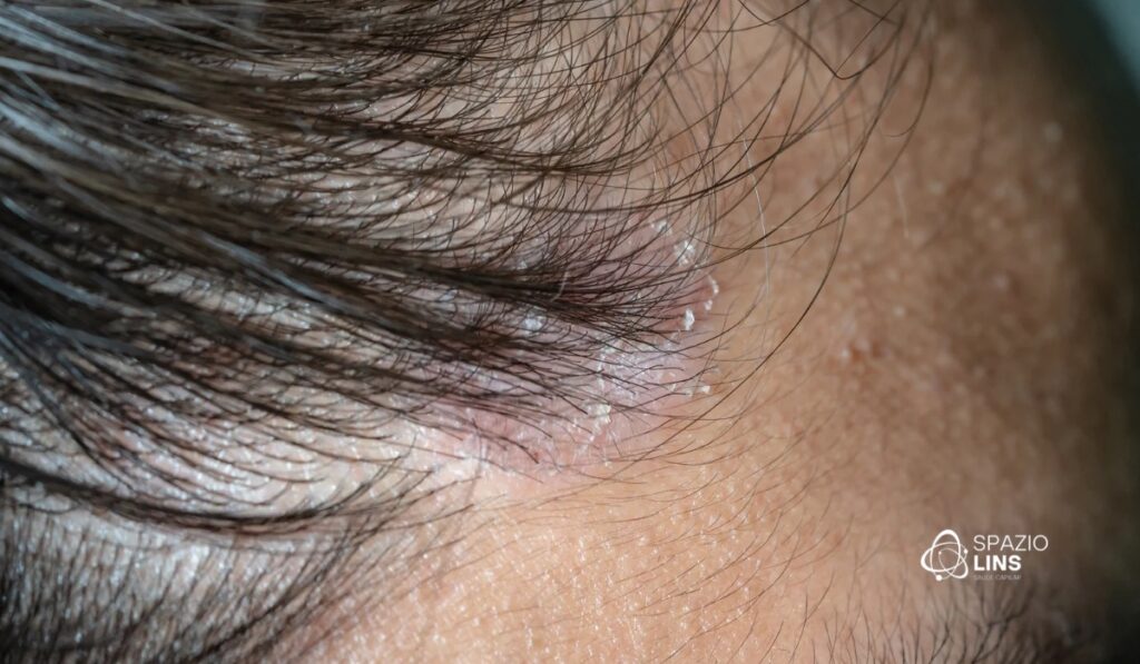 O que pode desencadear uma crise de dermatite seborreica no couro cabeludo?