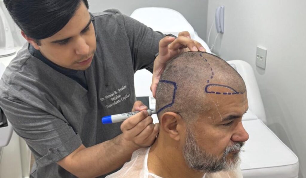 O Transplante Capilar é Definitivo?
