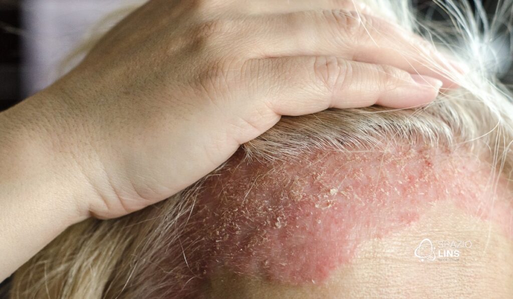 Spazio Lins: Inovação no Tratamento da Dermatite Seborreica