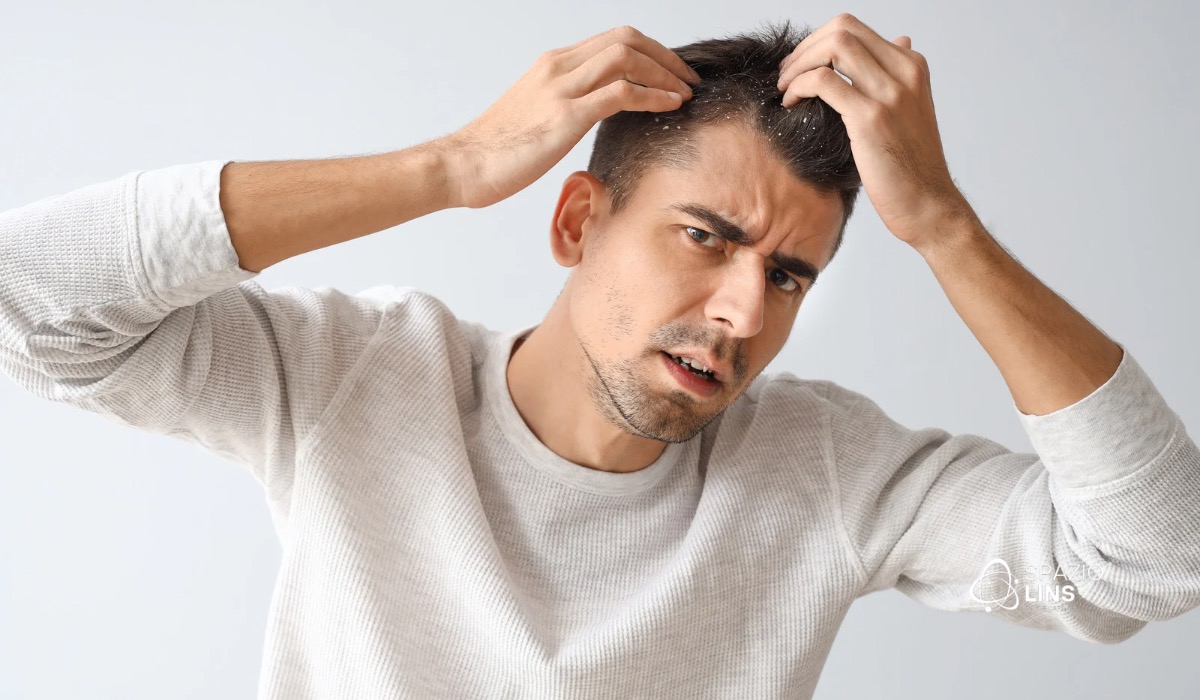 O que é Dermatite Seborreica?