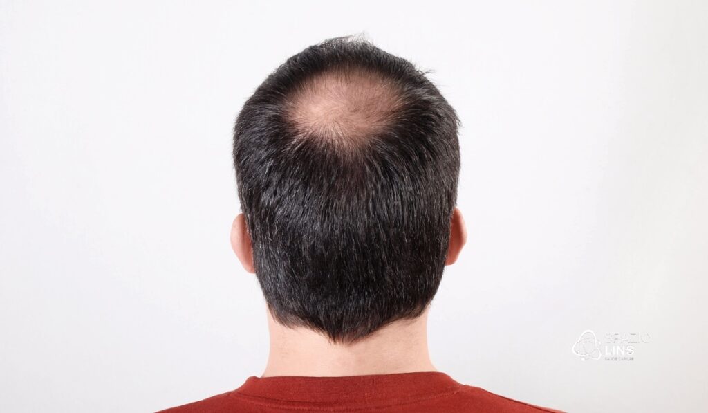 O que é alopecia androgenética? Entenda as causas, sintomas e tratamentos