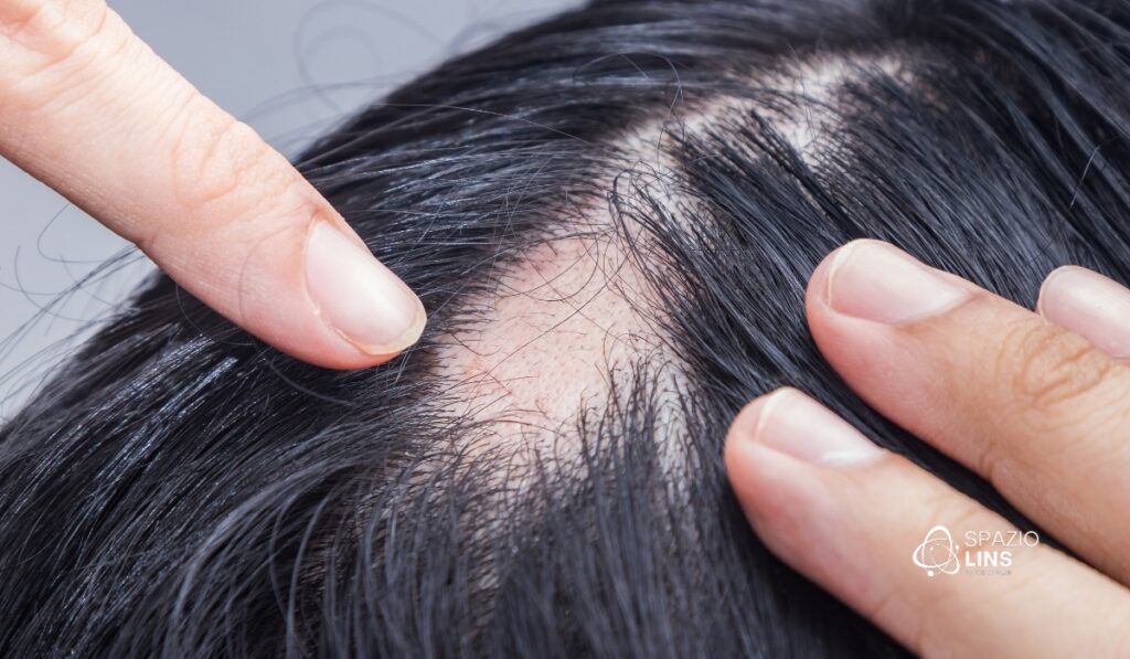 Quem tem alopecia areata o cabelo volta a crescer?