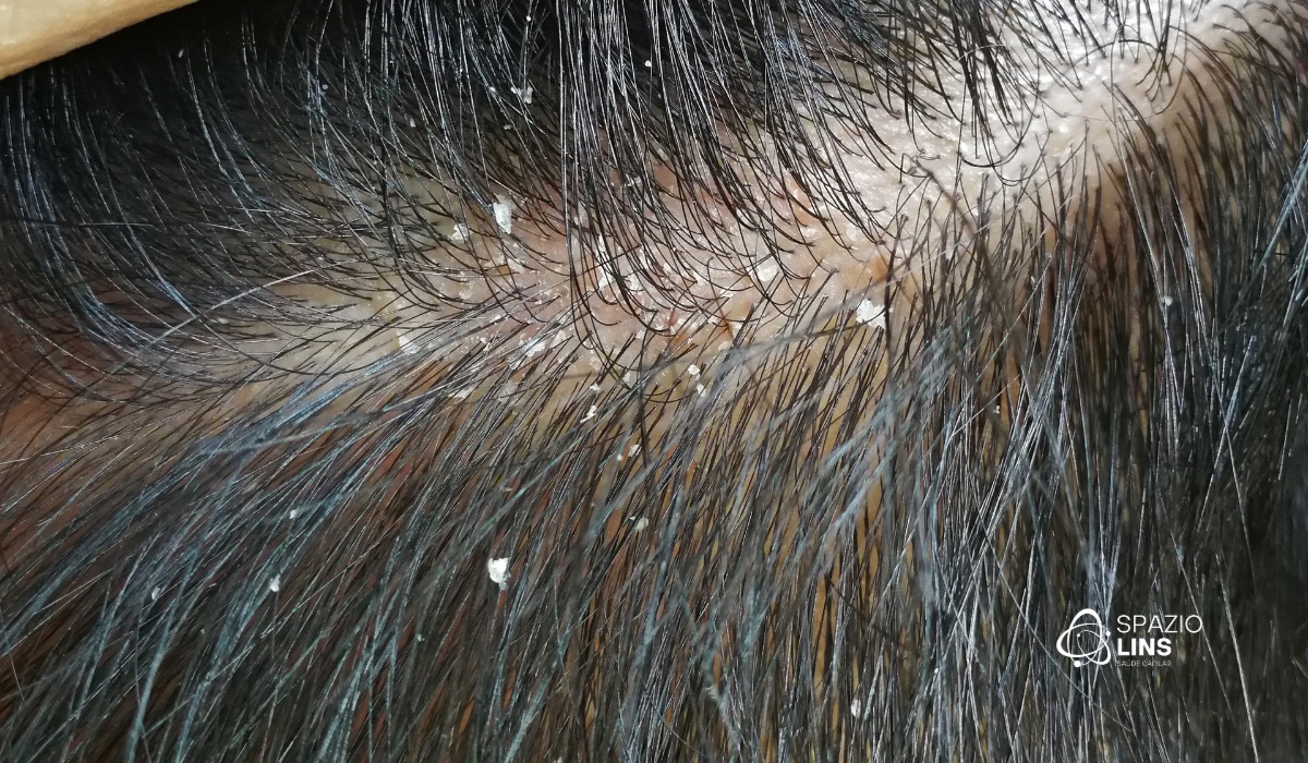 Caspa ou Dermatite Seborreica? Como saber?