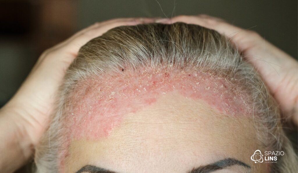 Caspa ou Dermatite Seborreica? Como saber?