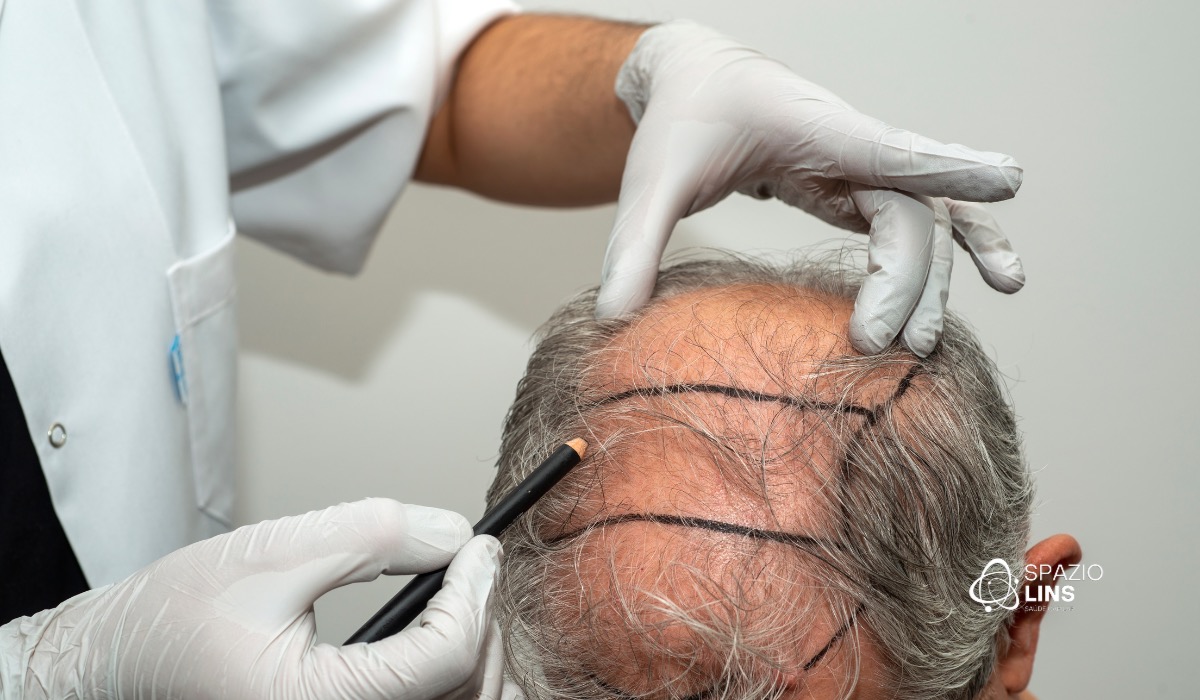 Ainda é possível fazer transplante capilar nesses casos?