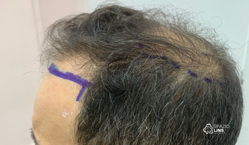 Entradas, rarefação ou calvície total: quando o transplante capilar é indicado?