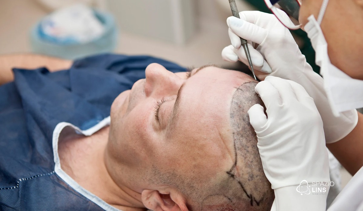 Pós-transplante capilar: como garantir que os fios cresçam saudáveis?