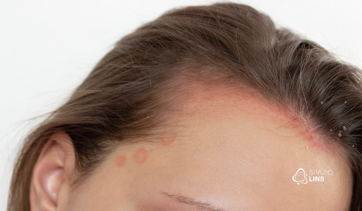 Como identificar inflamação silenciosa no couro cabeludo? Saiba os sinais, causas e o que fazer