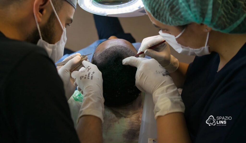 Por que fazer transplante sem tratamento capilar é um erro?