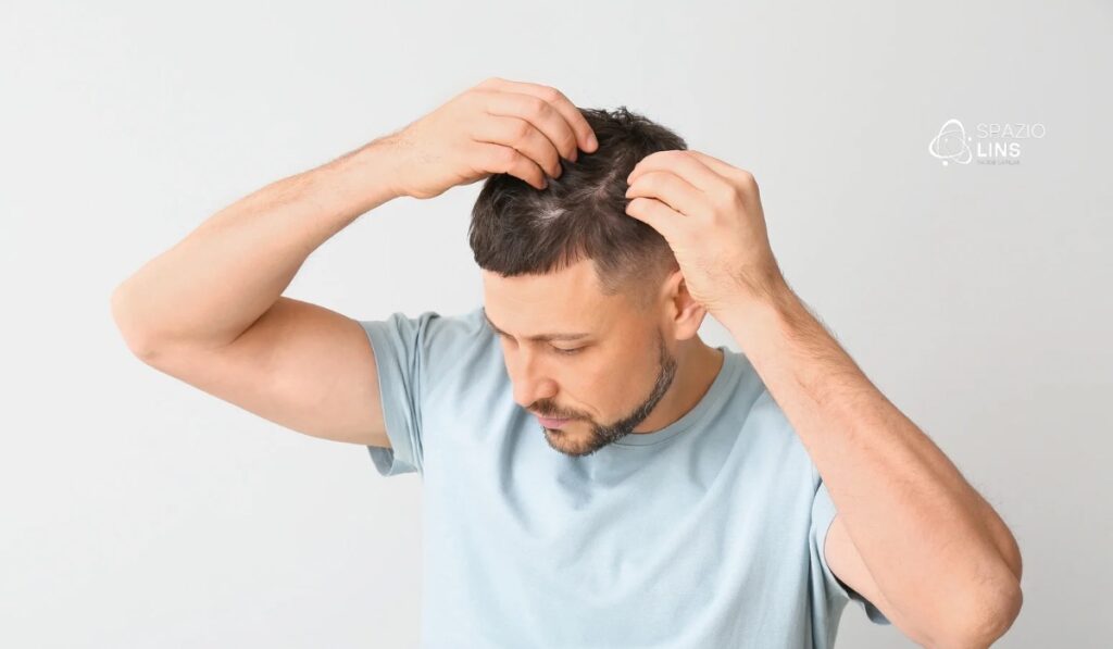 Minoxidil causa queda no início? Entenda o shedding