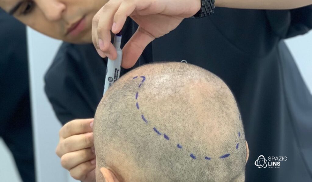 O que fazer antes e depois do transplante capilar? Dicas para um resultado perfeito