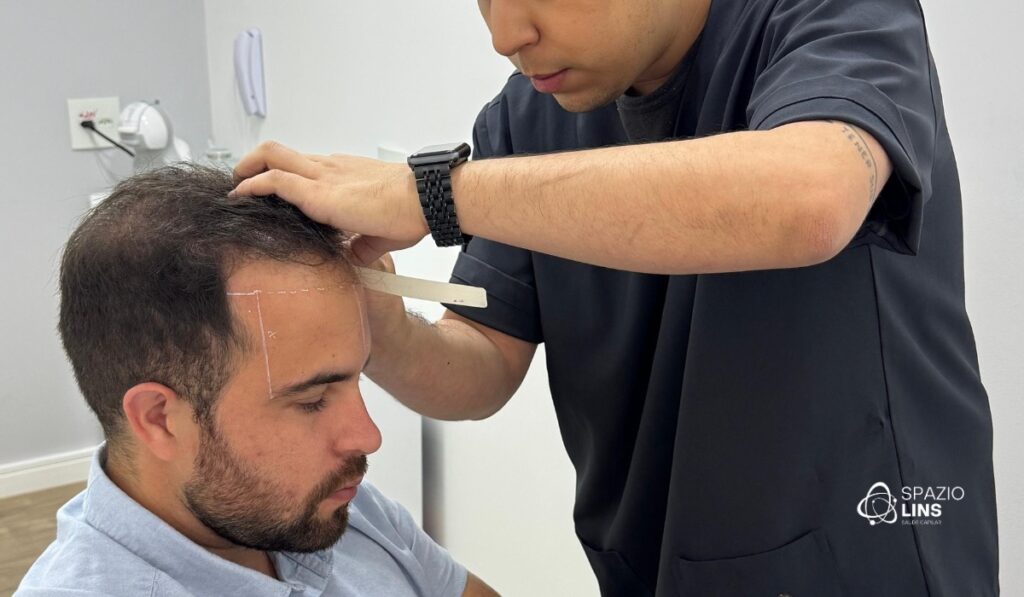 Transplante capilar personalizado: como a tricologia define seu protocolo ideal