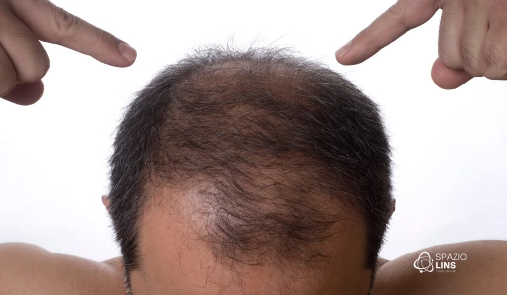 Cabelo ralo e afinando? Saiba como identificar a miniaturização dos fios