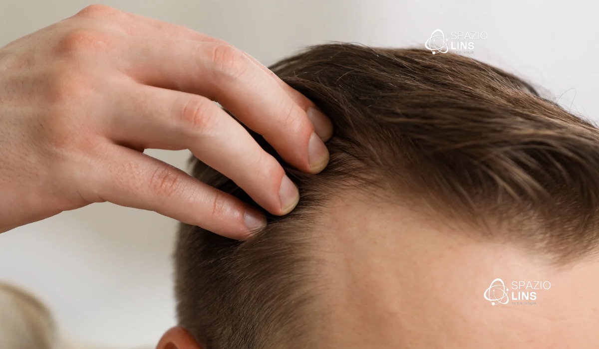 Calvície masculina precoce: sinais que não devem ser ignorados