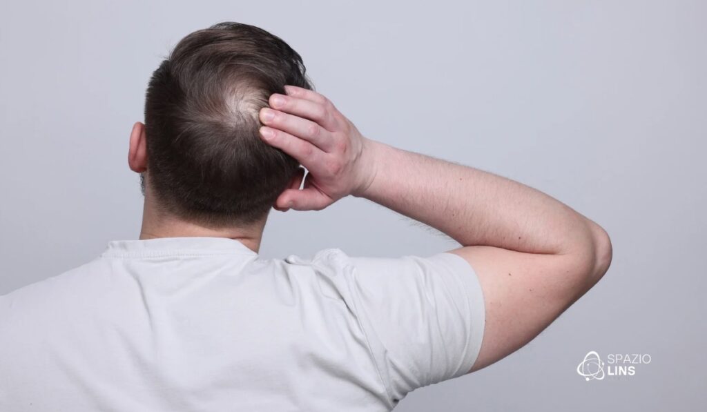 Calvície masculina precoce: sinais que não devem ser ignorados