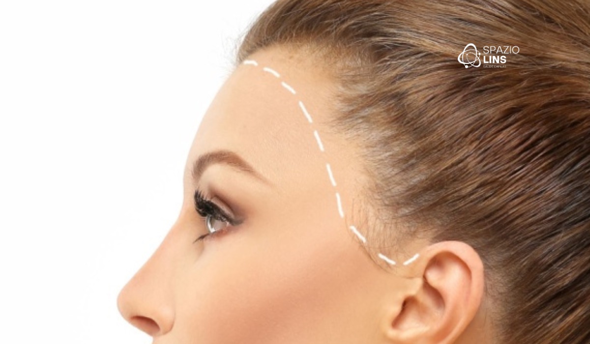 Alopecia Frontal Fibrosante: O que a Ciência Já Descobriu Sobre Essa Condição