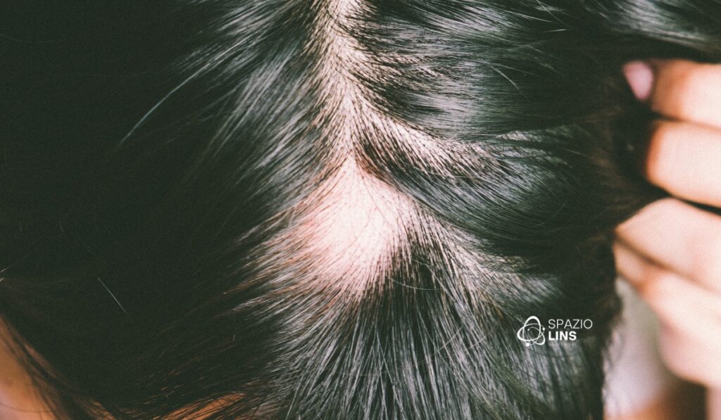 Alopecia Areata: Quando o Cabelo Volta a Crescer e Como Acelerar o Processo