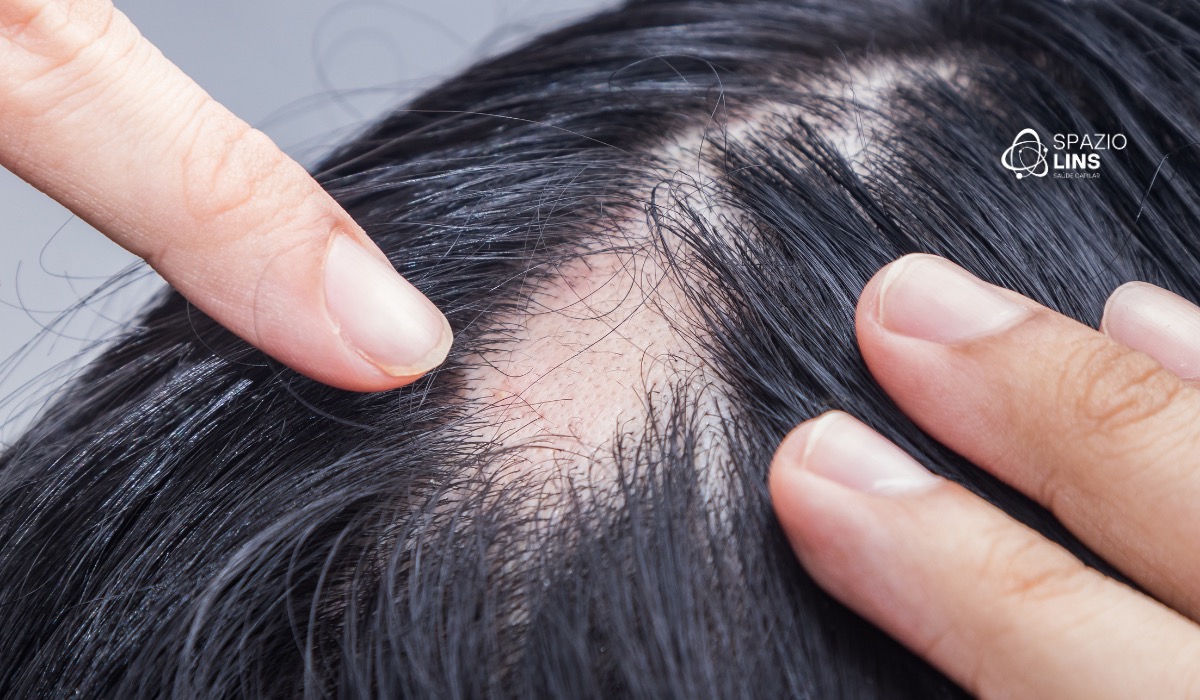 Alopecia Areata: Quando o Cabelo Volta a Crescer e Como Acelerar o Processo