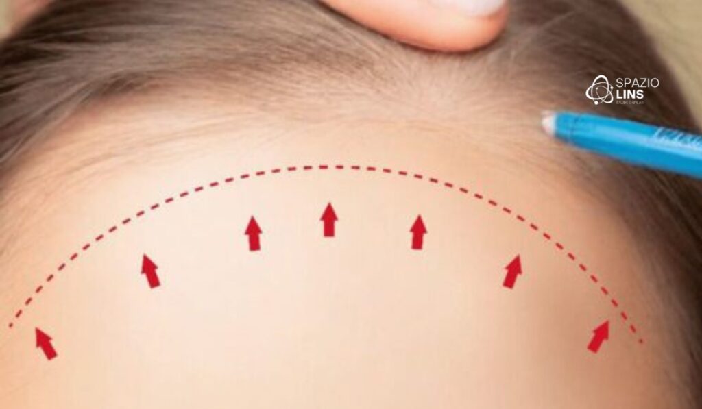 Alopecia Frontal Fibrosante: O que a Ciência Já Descobriu Sobre Essa Condição