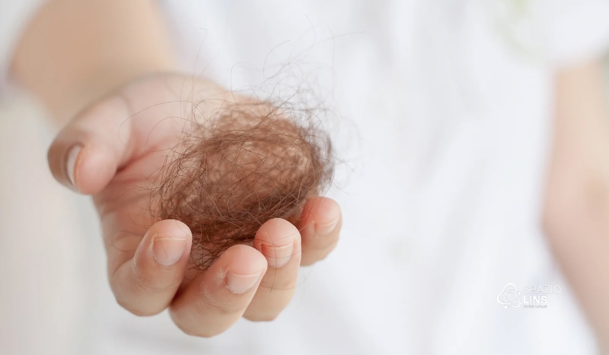 Eflúvio Telógeno: Queda de Cabelo Temporária ou Início de Calvície?