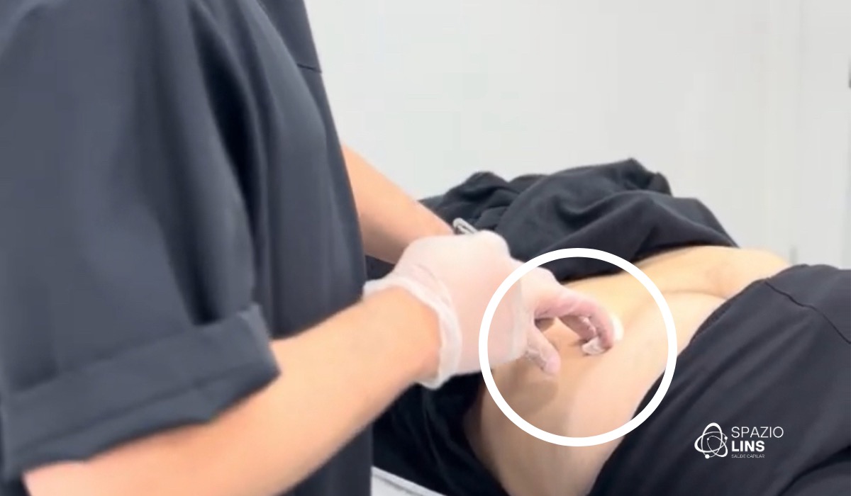 Chip capilar: como a nova tecnologia potencializa os resultados do transplante