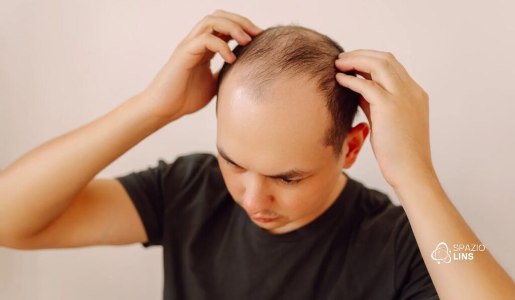 Calvície não é só genética: fatores que ninguém te contou