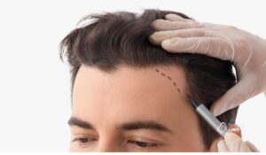 Transplante capilar: para quem a técnica é indicada e como funciona