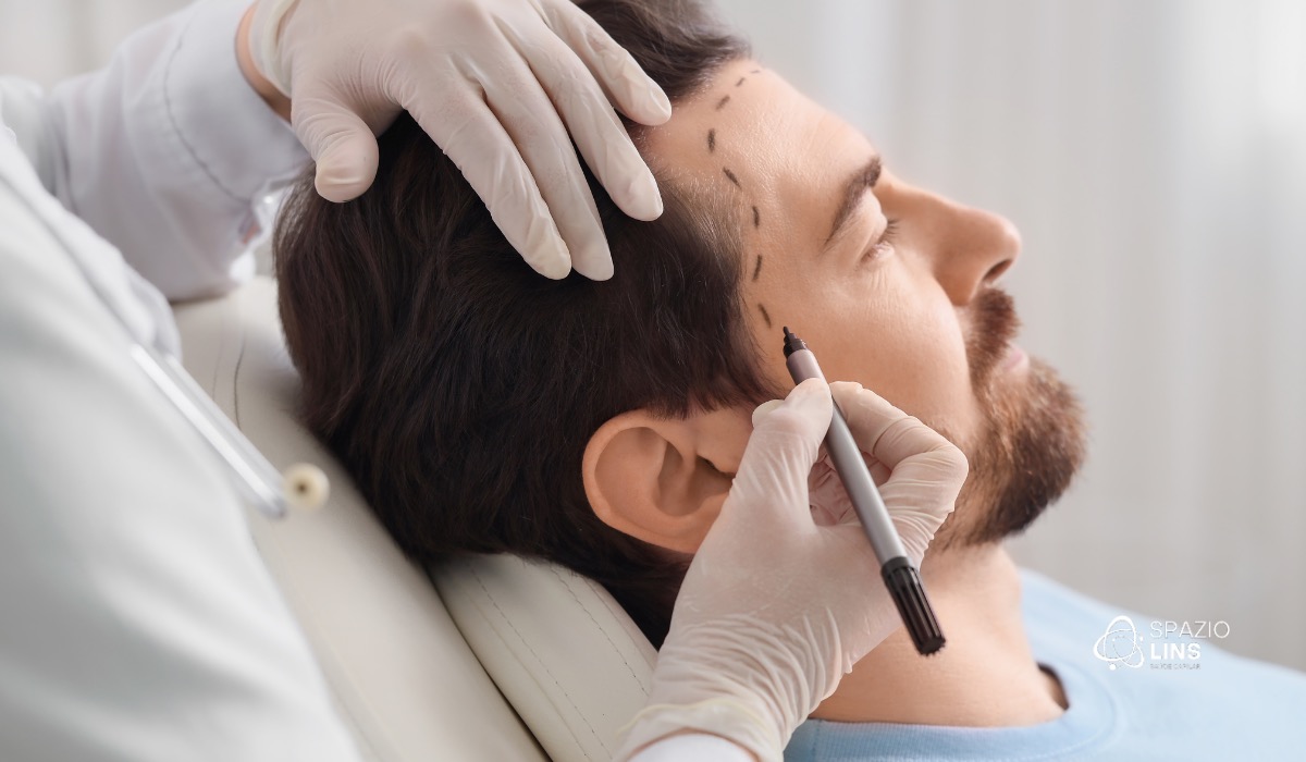 Transplante capilar: para quem a técnica é indicada e como funciona