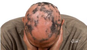 Alopecia cicatricial: entenda o que é, causas e tratamentos disponíveis