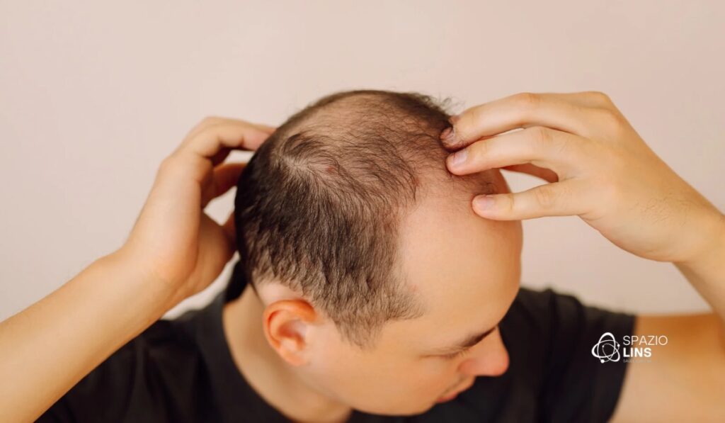 A calvície pode voltar depois do tratamento? Entenda os risco