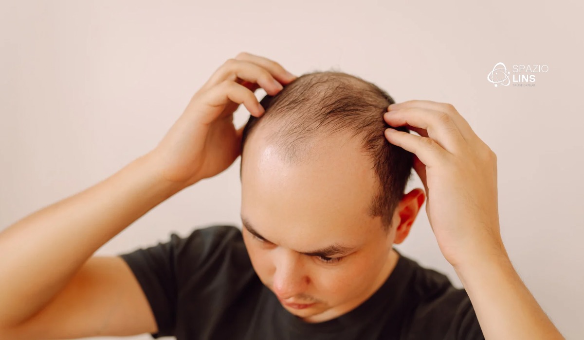 A calvície pode voltar depois do tratamento? Entenda os risco