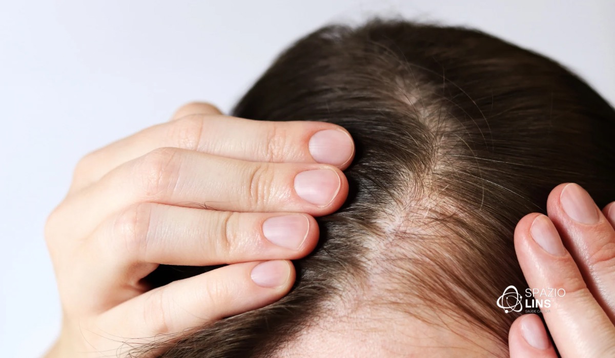 Alopecia androgenética padrão feminino: tem cura?
