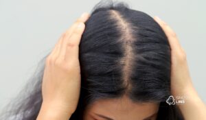 Alopecia feminina: por que ela é diferente da masculina e o que toda mulher precisa saber