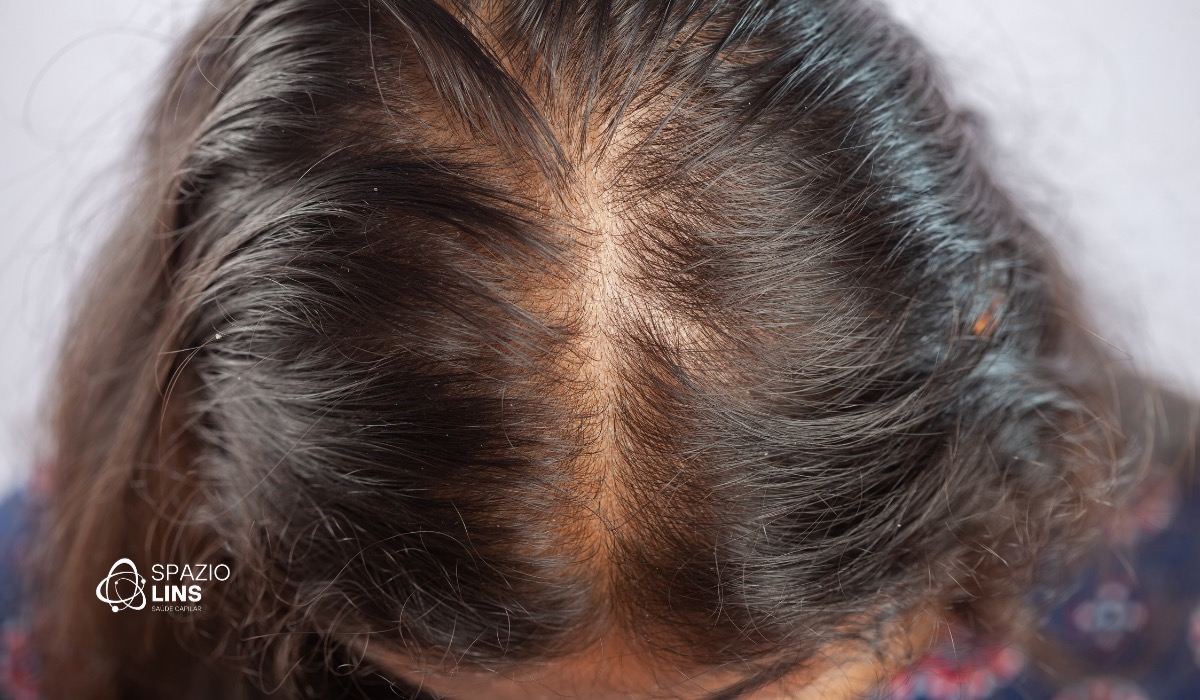 Alopecia feminina: por que ela é diferente da masculina e o que toda mulher precisa saber
