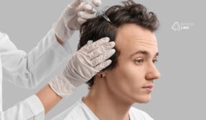 Calvície precoce: como identificar e prevenir a alopecia antes dos 30 anos