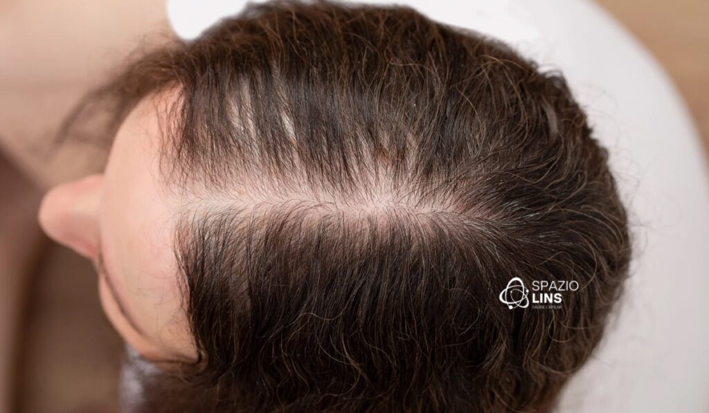 Calvície feminina por que acontece e quais são os melhores tratamentos