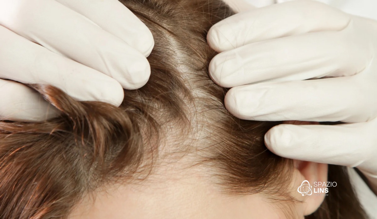 Calvície feminina por que acontece e quais são os melhores tratamentos