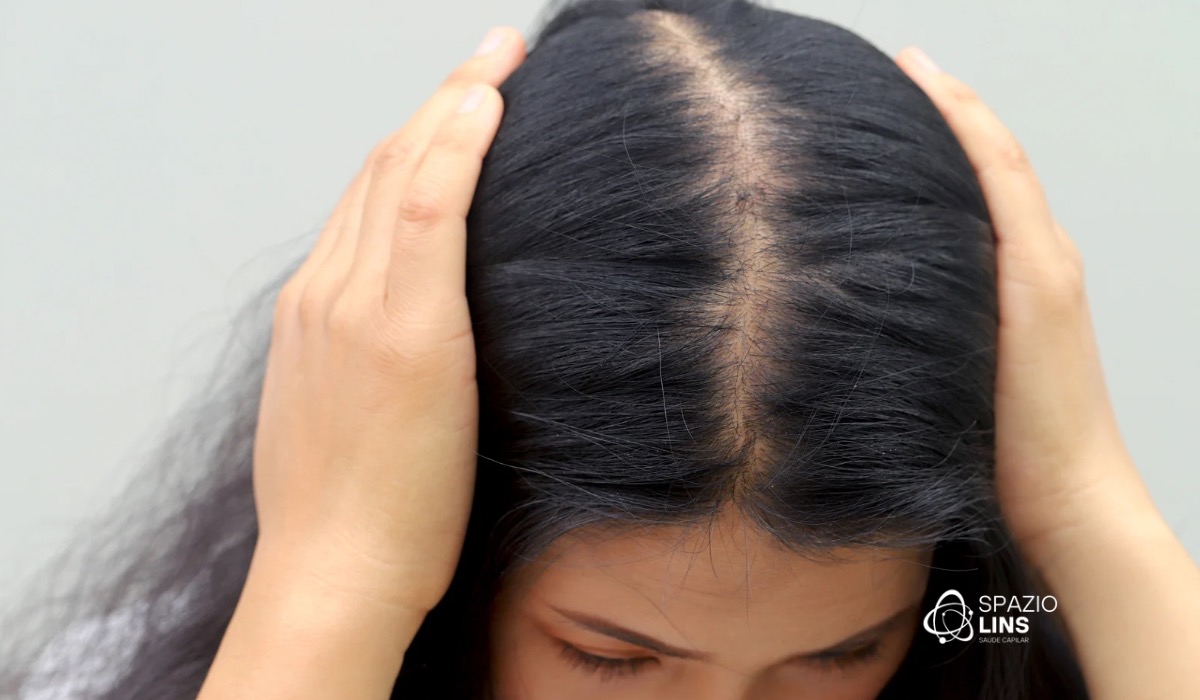 Queda de cabelo pós-gravidez e pós-parto: causas, diagnóstico e tratamento