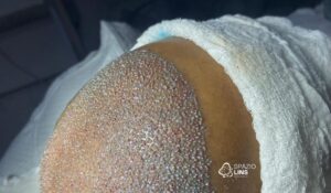 Transplante capilar: cuidados pré e pós procedimento para garantir bons resultados e evitar rejeição