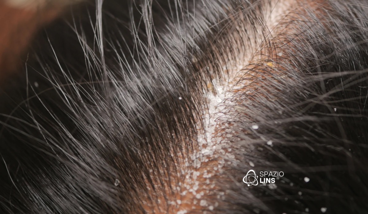 Quando o couro cabeludo inflama: causas, consequências e tratamento preventivo