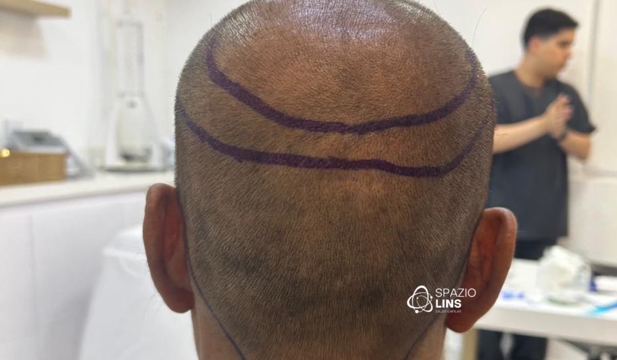 Transplante capilar: cuidados pré e pós procedimento para garantir bons resultados e evitar rejeição