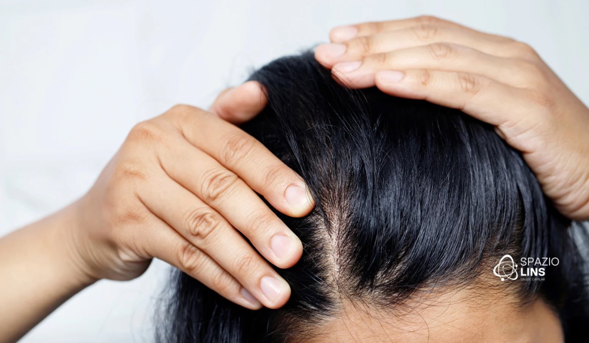 Calvície feminina: por que acontece e quais são os melhores tratamentos?